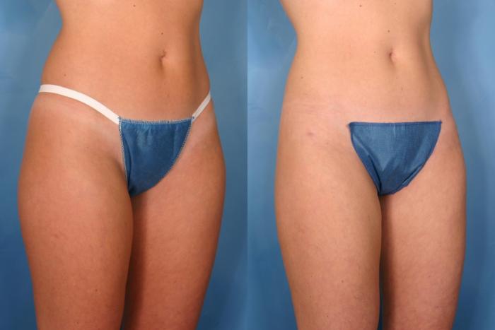 Before & After Liposuction Case 25 View #2 View in Naples and Ft. Myers, FL