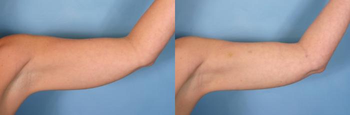 Before & After Liposuction Case 28 View #1 View in Naples and Ft. Myers, FL