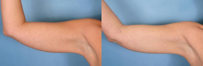 Before & After Liposuction Case 28 View #2 View in Naples and Ft. Myers, FL
