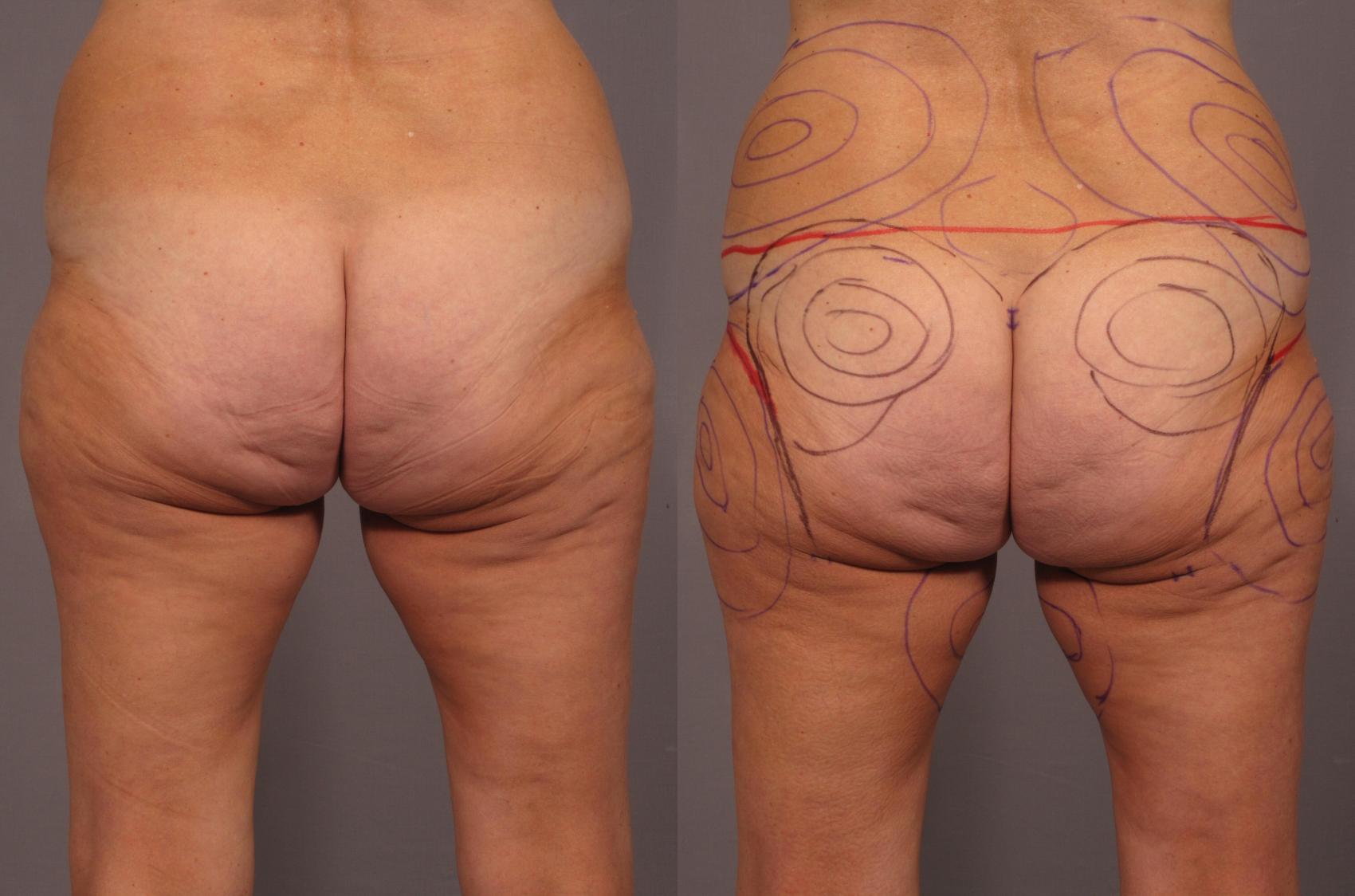 Before & After Liposuction Case 292 View #1 View in Naples and Ft. Myers, FL