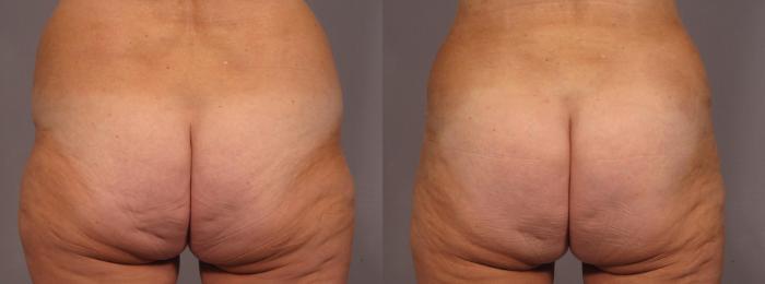 Before & After Liposuction Case 292 View #2 View in Naples and Ft. Myers, FL