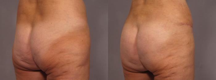 Before & After Liposuction Case 292 View #3 View in Naples and Ft. Myers, FL