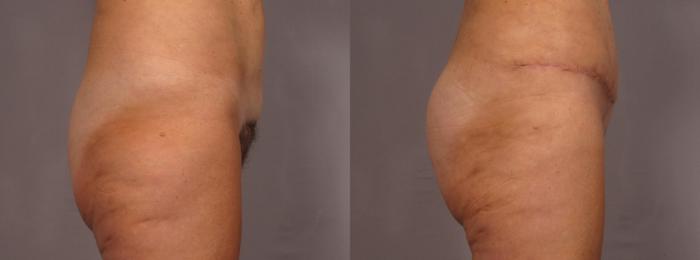 Before & After Liposuction Case 292 View #4 View in Naples and Ft. Myers, FL