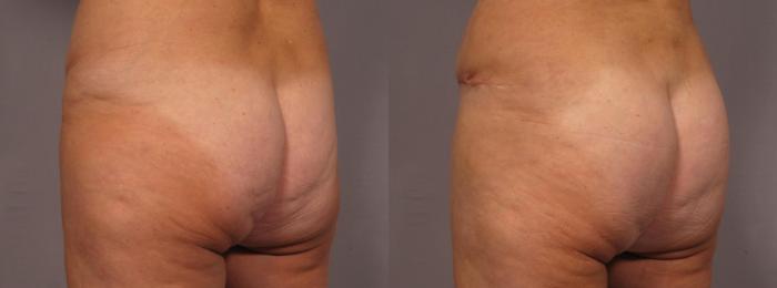 Before & After Liposuction Case 292 View #5 View in Naples and Ft. Myers, FL