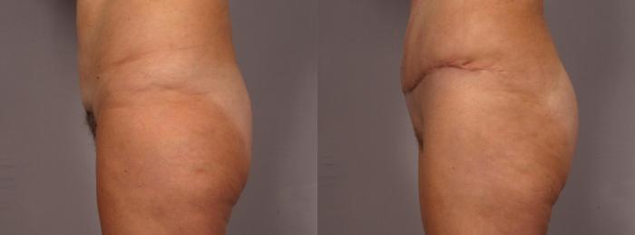 Before & After Liposuction Case 292 View #6 View in Naples and Ft. Myers, FL