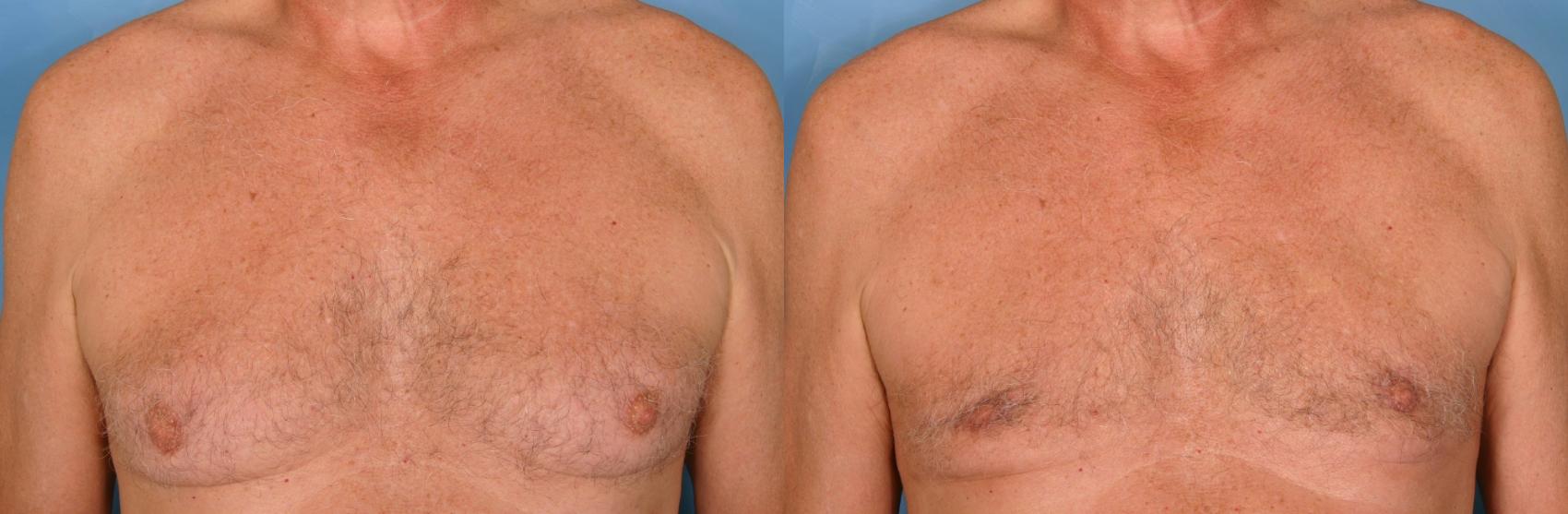 Before & After Liposuction Case 30 View #1 View in Naples and Ft. Myers, FL