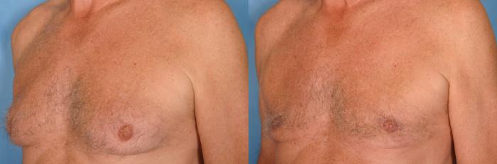 Before & After Liposuction Case 30 View #2 View in Naples and Ft. Myers, FL