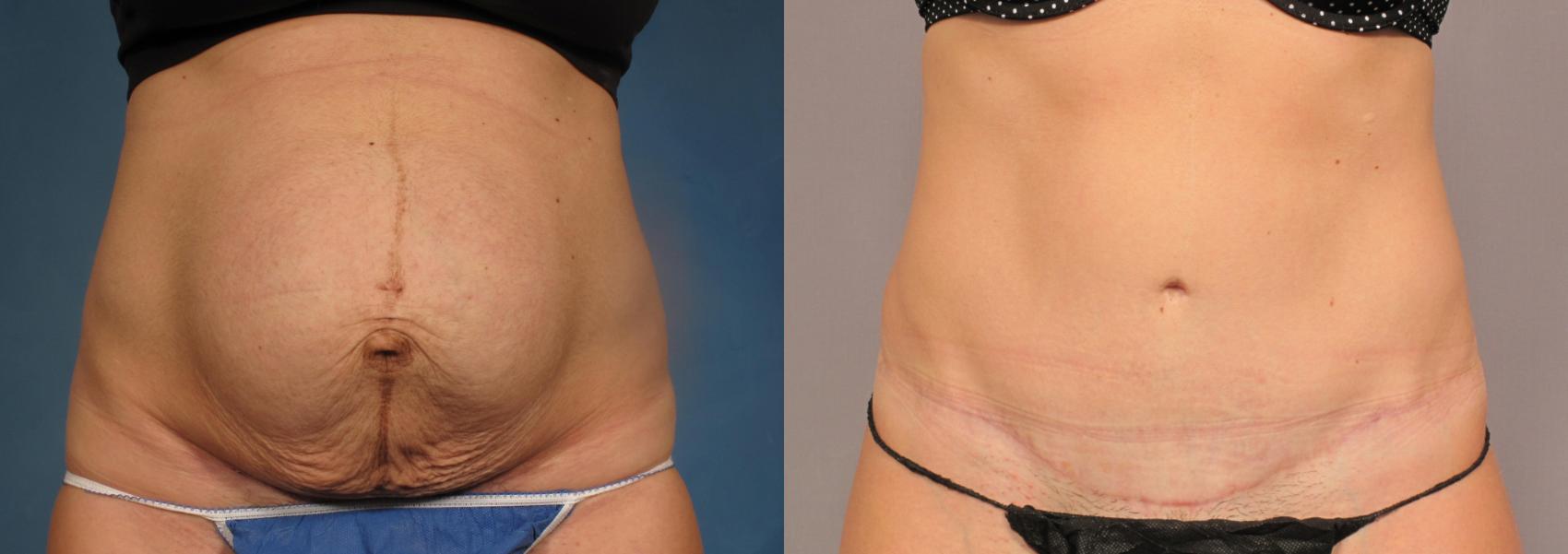Before & After Liposuction Case 305 View #1 View in Naples and Ft. Myers, FL