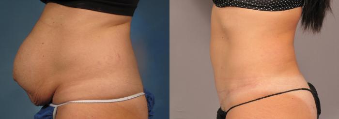Before & After Liposuction Case 305 View #2 View in Naples and Ft. Myers, FL