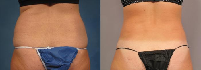 Before & After Liposuction Case 305 View #3 View in Naples and Ft. Myers, FL