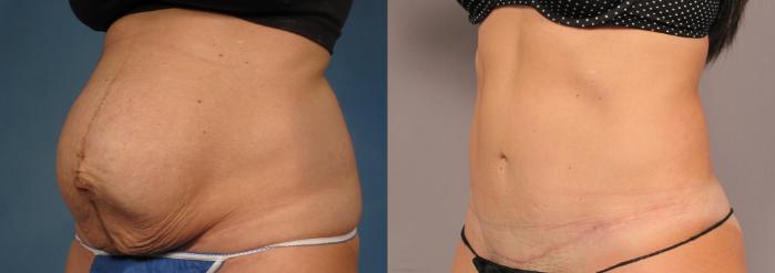 Before & After Liposuction Case 305 View #4 View in Naples and Ft. Myers, FL