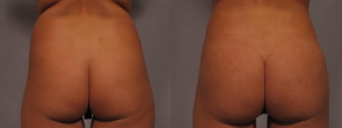 Before & After Liposuction Case 327 View #1 View in Naples and Ft. Myers, FL