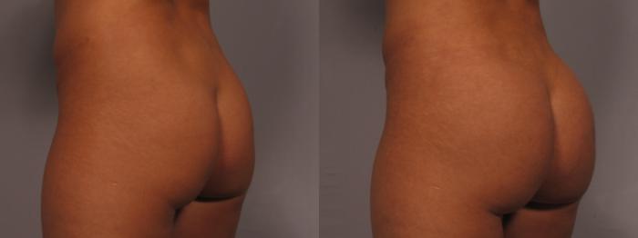 Before & After Liposuction Case 327 View #2 View in Naples and Ft. Myers, FL