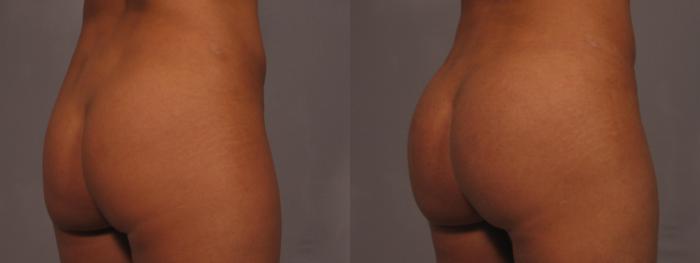 Before & After Liposuction Case 327 View #3 View in Naples and Ft. Myers, FL