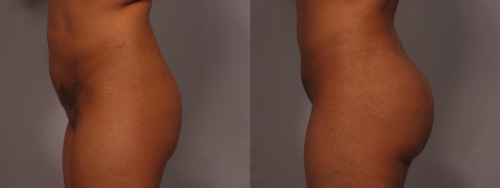 Before & After Liposuction Case 327 View #4 View in Naples and Ft. Myers, FL