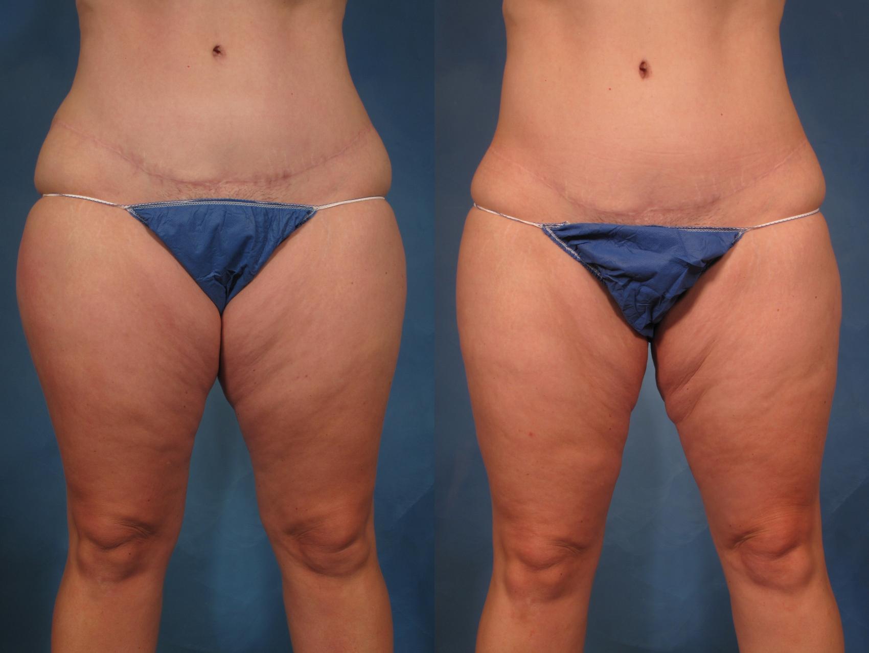 Which Is Better, Liposuction or CoolSculpting®? – Kent V. Hasen, MD