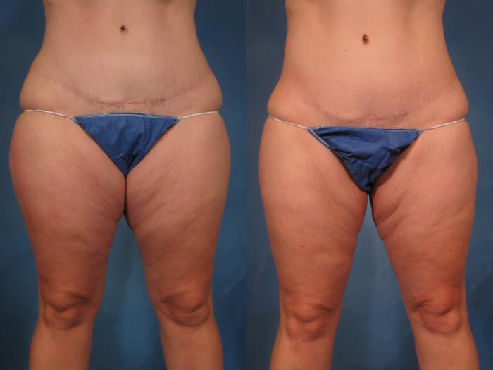 Liposuction of Thighs/Hips Before and 1 Year After, Front View