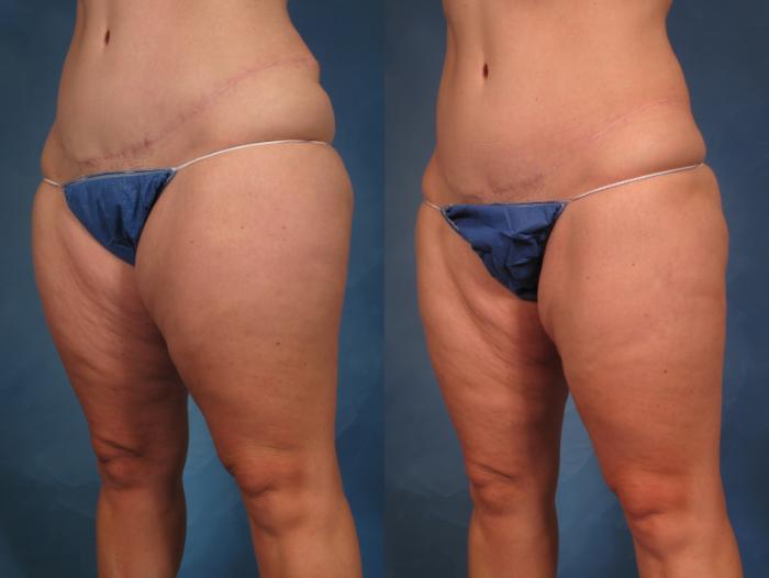 Liposuction of Thighs/Hips Before and 1 Year After, Left Oblique View