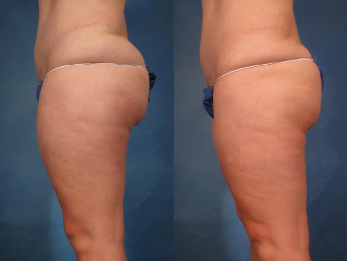 Liposuction of Thighs/Hips Before and 1 Year After, Left Side View