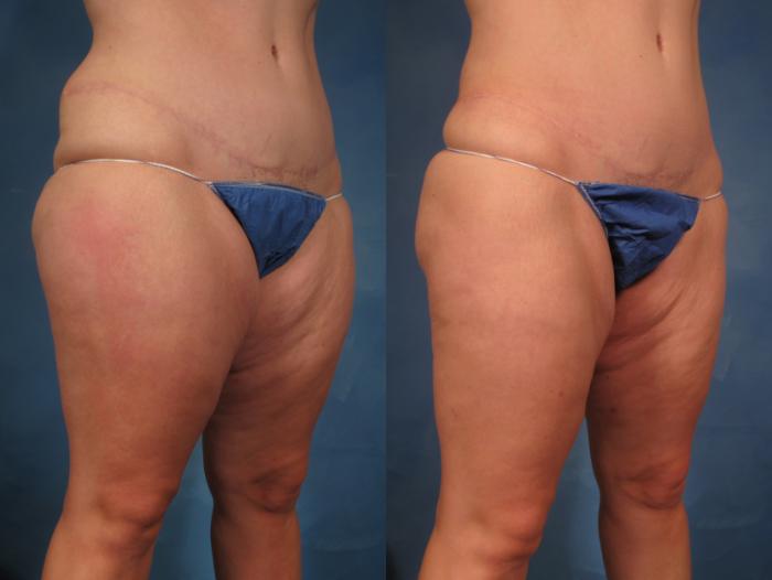 Liposuction of Thighs/Hips Before and 1 Year After, Right Oblique View