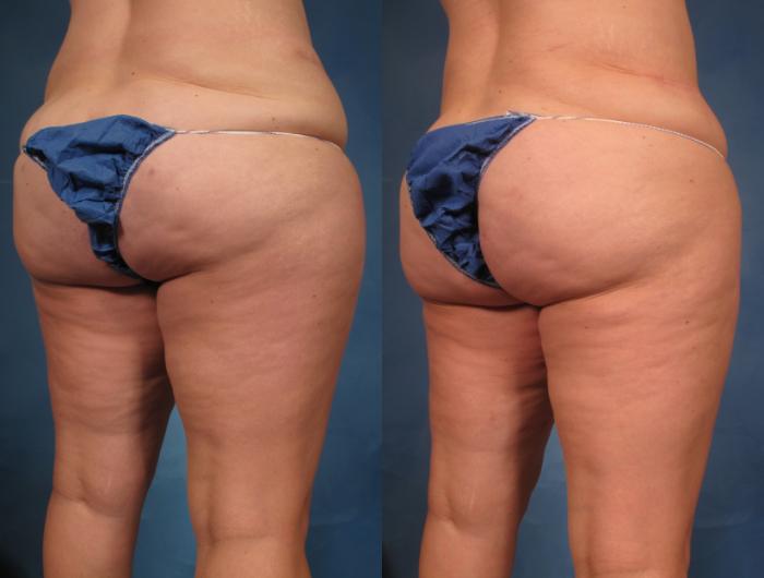 Liposuction of Thighs/Hips Before and 1 Year After, Right Posterior Oblique View