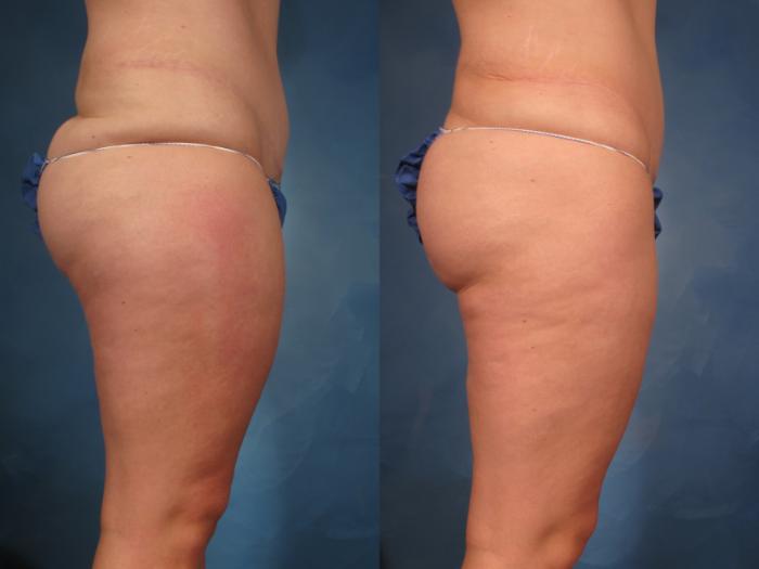 Liposuction of Thighs/Hips Before and 1 Year After, Right Side View