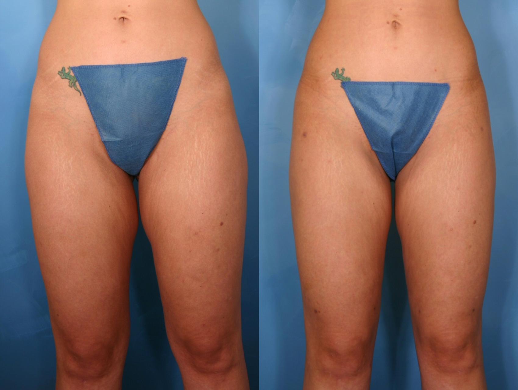 Before & After Liposuction Case 42 View #1 View in Naples and Ft. Myers, FL