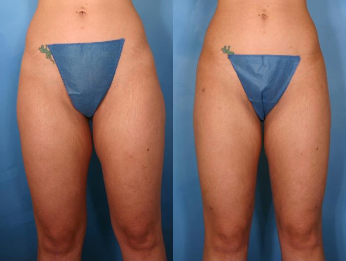 Before & After Liposuction Case 42 View #1 View in Naples and Ft. Myers, FL