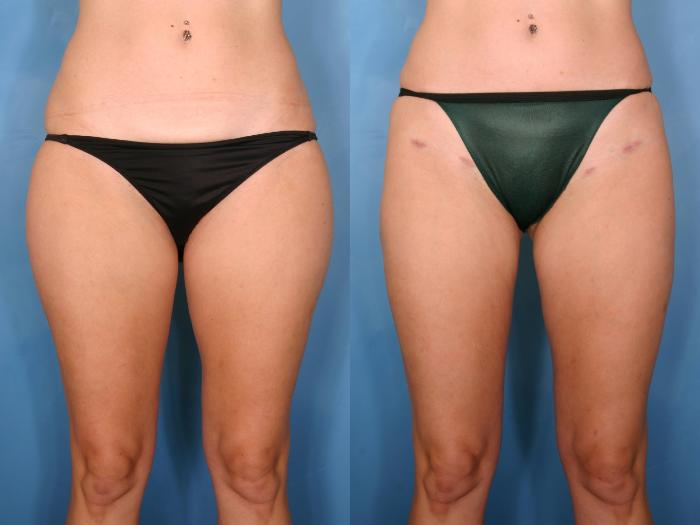 Before & After Liposuction Case 82 View #1 View in Naples and Ft. Myers, FL