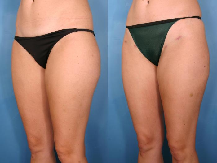 Before & After Liposuction Case 82 View #2 View in Naples and Ft. Myers, FL