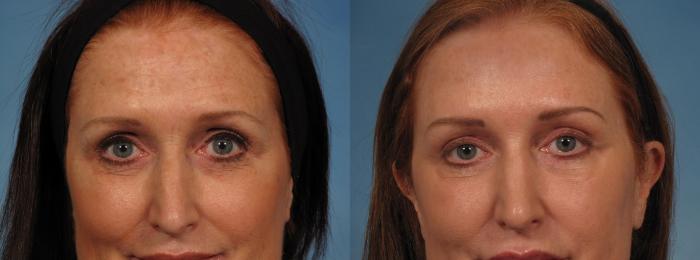 Before & After Madonna Lift Case 283 View #1 View in Naples and Ft. Myers, FL