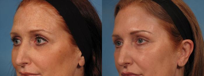 Before & After Madonna Lift Case 283 View #2 View in Naples and Ft. Myers, FL