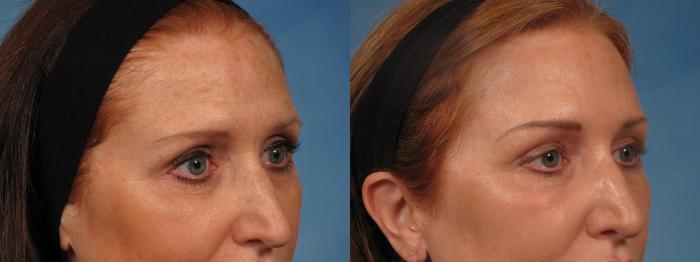 Before & After Madonna Lift Case 283 View #3 View in Naples and Ft. Myers, FL