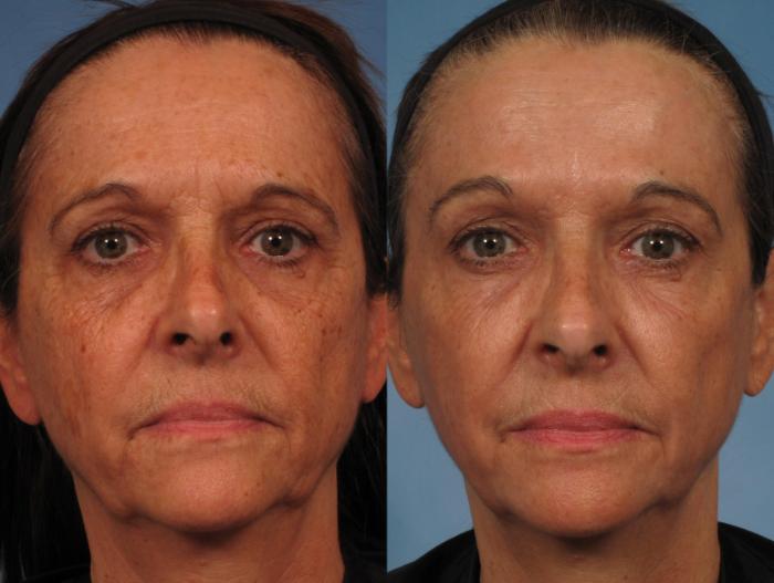 Before & After Madonna Lift Case 284 View #1 View in Naples and Ft. Myers, FL