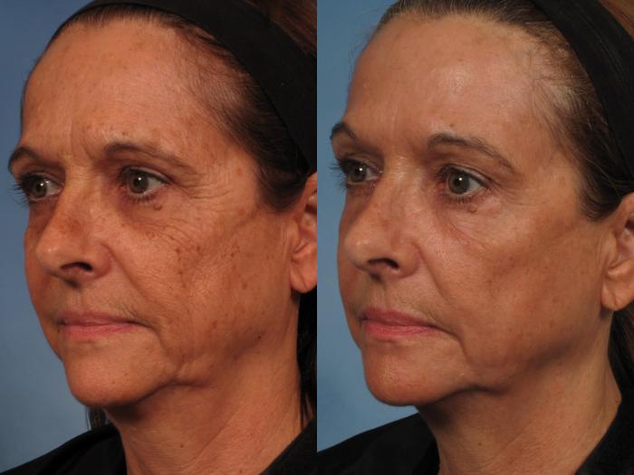Before & After Madonna Lift Case 284 View #2 View in Naples and Ft. Myers, FL