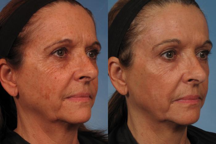 Before & After Madonna Lift Case 284 View #3 View in Naples and Ft. Myers, FL