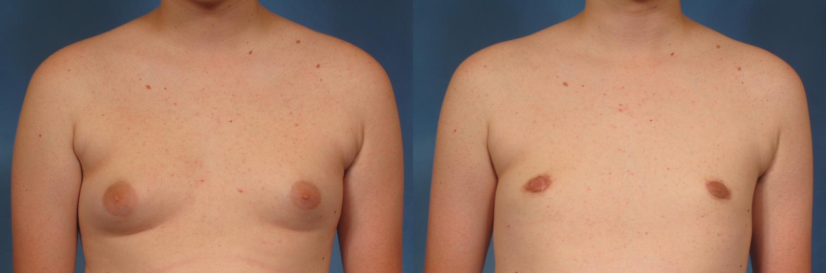 Before & After Male Breast Reduction Case 147 View #1 View in Naples and Ft. Myers, FL