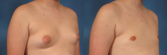 Before & After Male Breast Reduction Case 147 View #2 View in Naples and Ft. Myers, FL