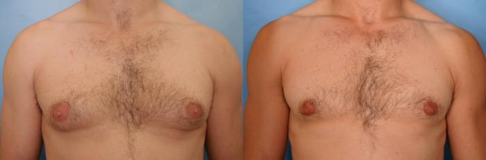 Before & After Male Breast Reduction Case 44 View #1 View in Naples and Ft. Myers, FL