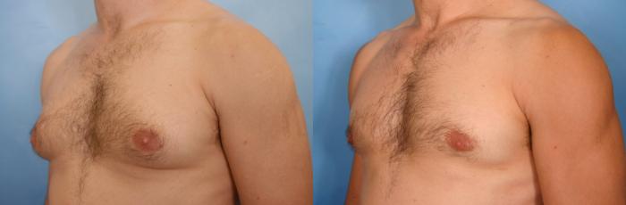 Before & After Male Breast Reduction Case 44 View #2 View in Naples and Ft. Myers, FL