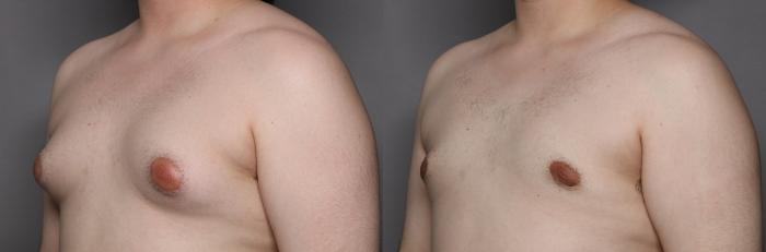 Male Breast Reduction (Gynecomastia) Left Oblique View Before
