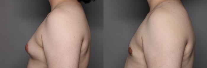 Male Breast Reduction (Gynecomastia) Left Side View Before