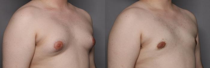 Male Breast Reduction (Gynecomastia) Right Oblique View Before