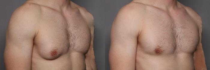 Right Oblique View of Gynecomastia - Male Breast Reduction