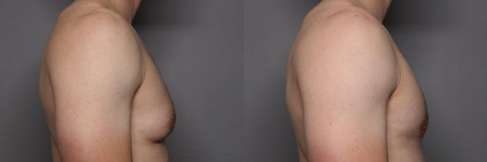 Right Side View of Gynecomastia - Male Breast Reduction