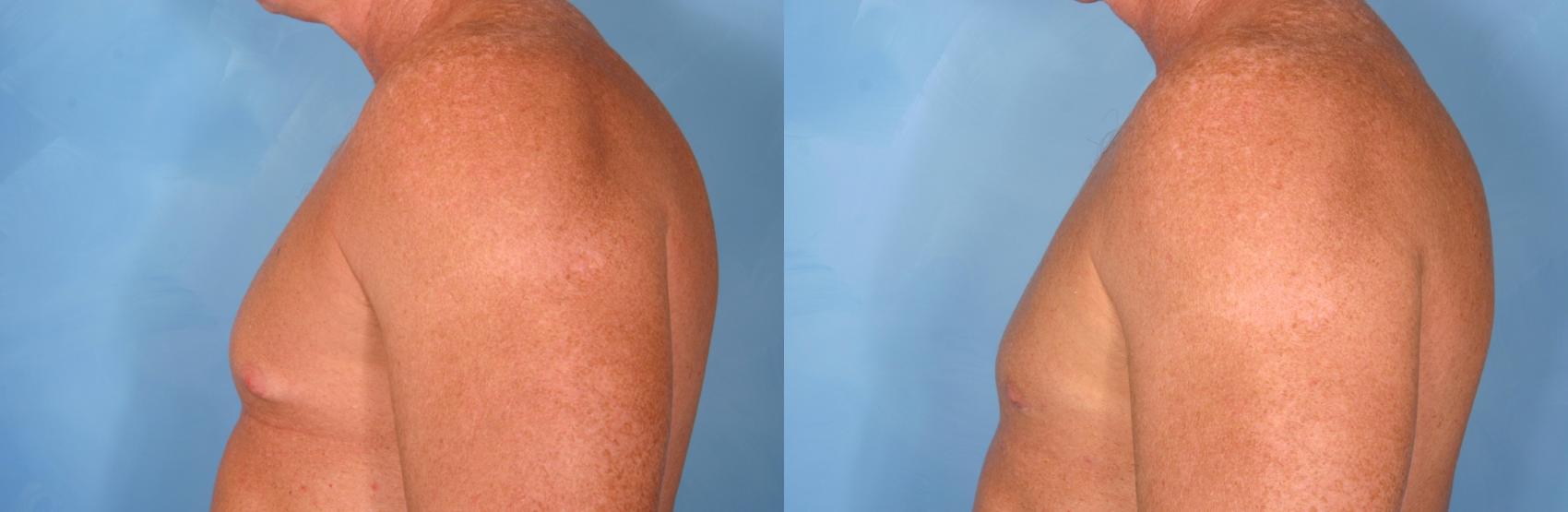 Am I Too Old for a Breast Lift?: Christopher Brooks, MD: Plastic Surgery