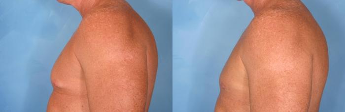 Before & After Male Breast Reduction Case 77 View #2 View in Naples and Ft. Myers, FL