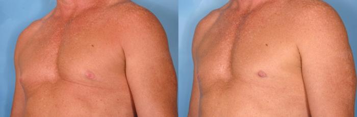 Before & After Male Breast Reduction Case 77 View #3 View in Naples and Ft. Myers, FL