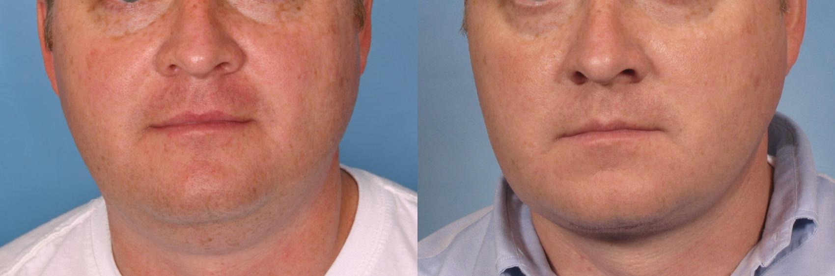 Male Face/Neck Lift Before and After Pictures Case 108, Naples and Ft.  Myers, FL