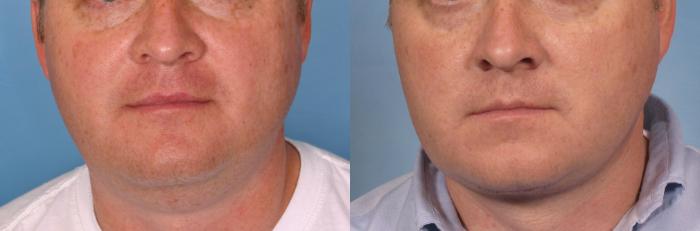 Before & After Male Face/Neck Lift Case 108 View #1 View in Naples and Ft. Myers, FL